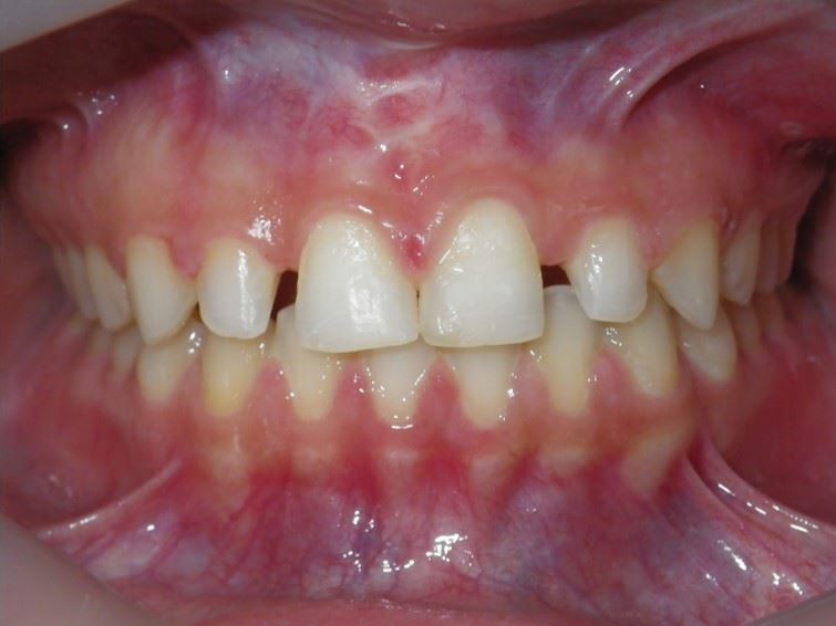 Resin Veneers Before Photo