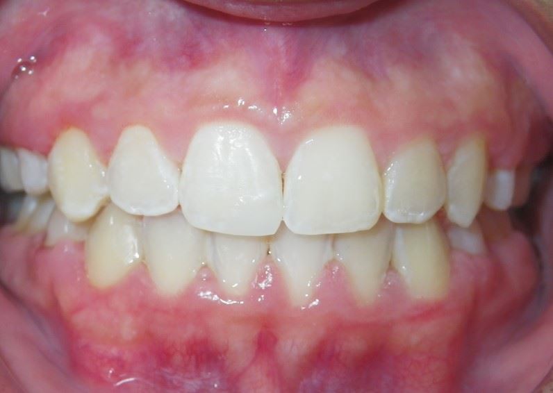 Resin Veneers After Photo