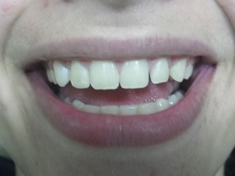 Anterior Resin Before Photo