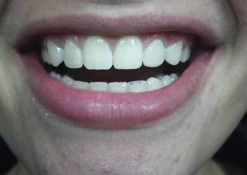 Anterior Resin After Photo