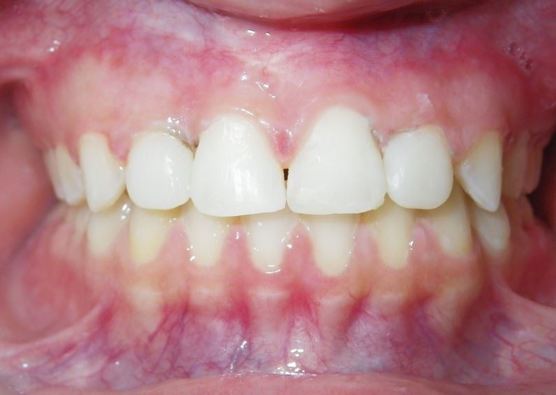 Anterior Resin After Photo