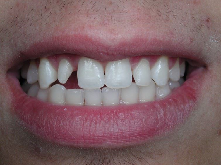 Resin Veneers Before Photo