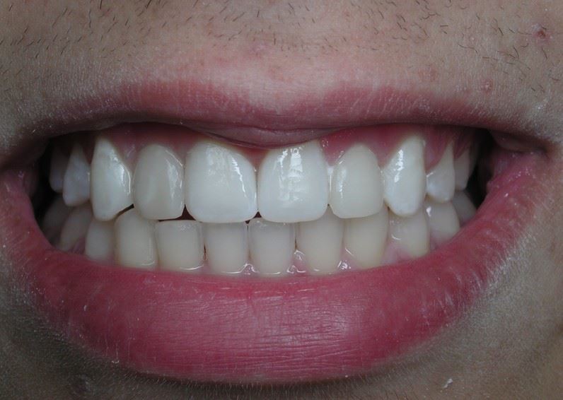 Resin Veneers After Photo