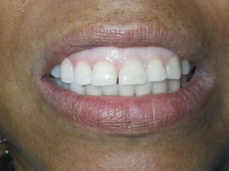 Resin Veneers Before Photo