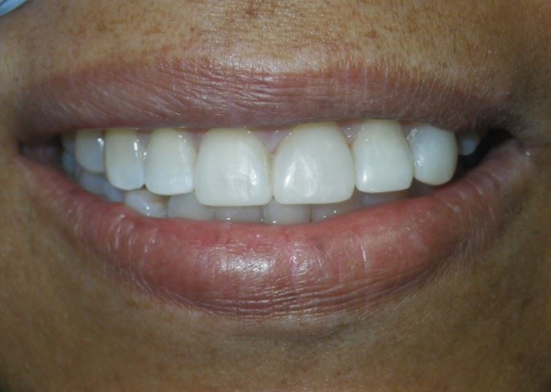 Resin Veneers After Photo