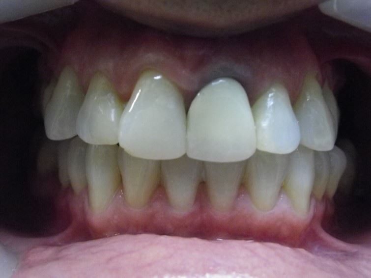 Porcelain Veneers Before Photo