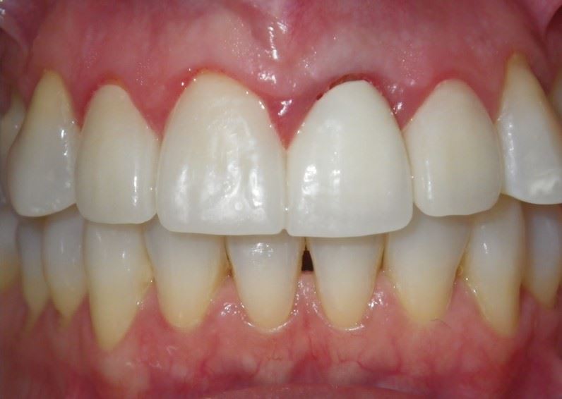 Porcelain Veneers After Photo