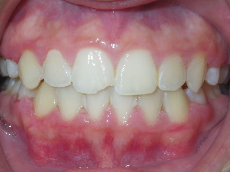 Anterior Resin Before Photo