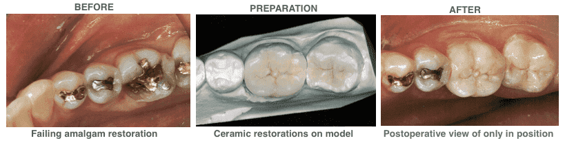 Before, Preparation and After photo of tooth colored fillings