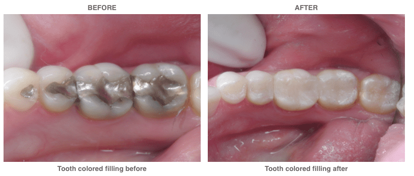 Before and after example of tooth colored filings