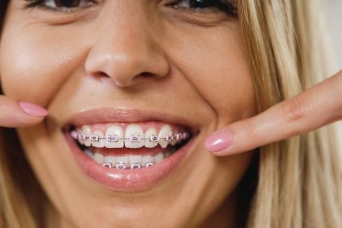 Girl wearing metal braces