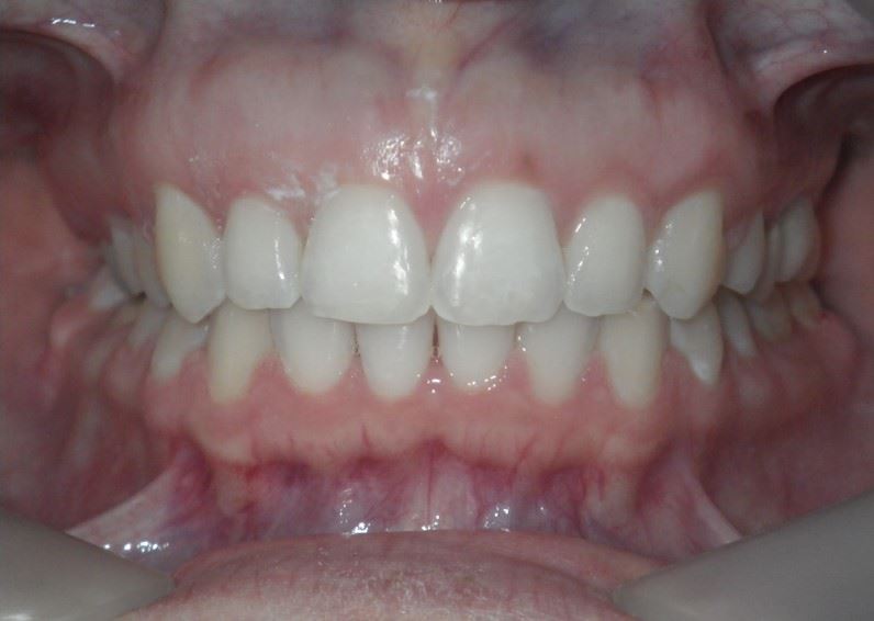 Case type:  Deep Bite After Photo