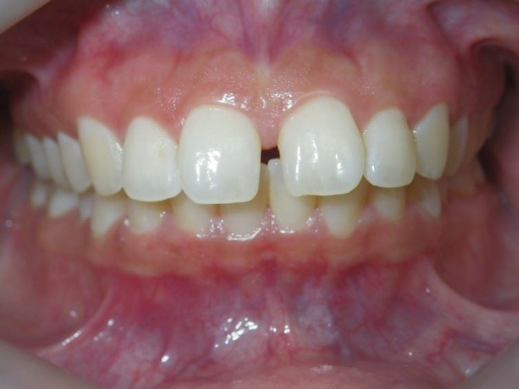 Case Type:  Diastema closure Before Photo