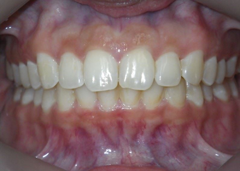 Case Type:  Diastema closure After Photo