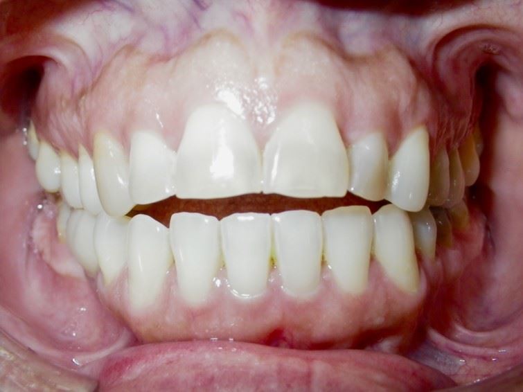 Case type:  Open Bite Before Photo