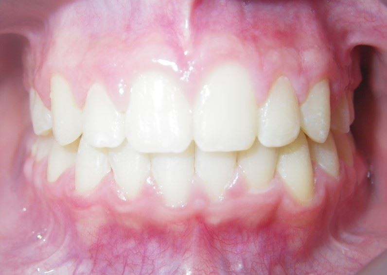 Case type:  Moderate Crowding After Photo