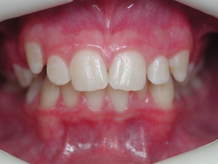 Case type: Blocked out canine Before Photo