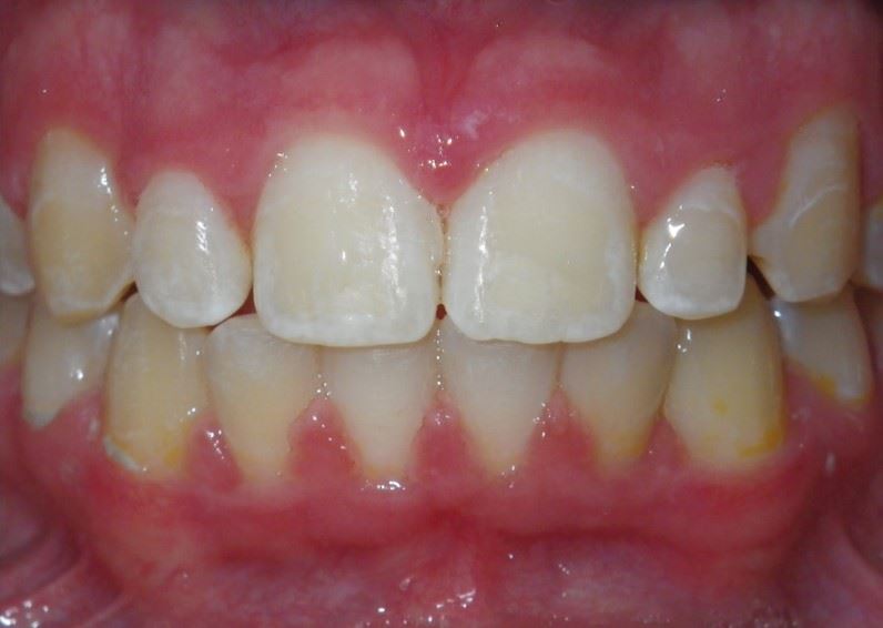 Case type: Blocked out canine After Photo