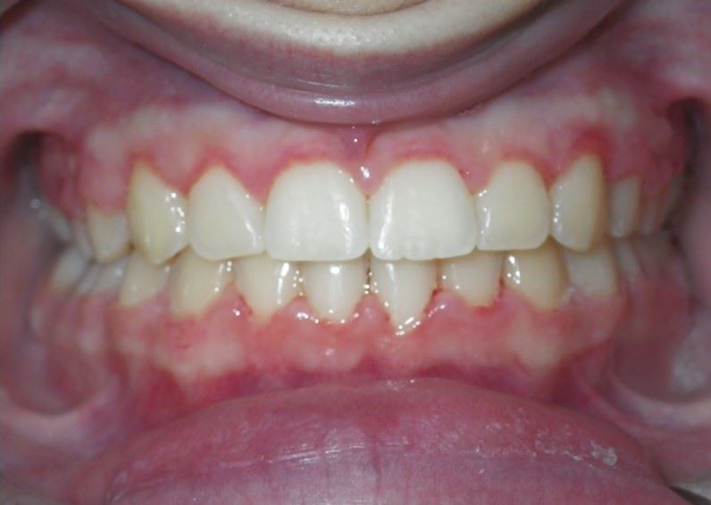 Case type: Mild Crowding After Photo