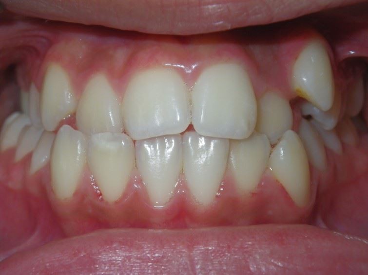 Case type: Anterior Crossbite Before Photo