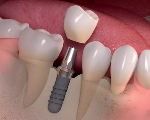 Rendering of a Dental Implant