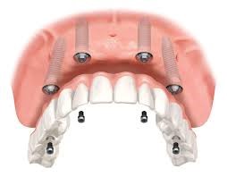 Diagram of Implants Being Placed 