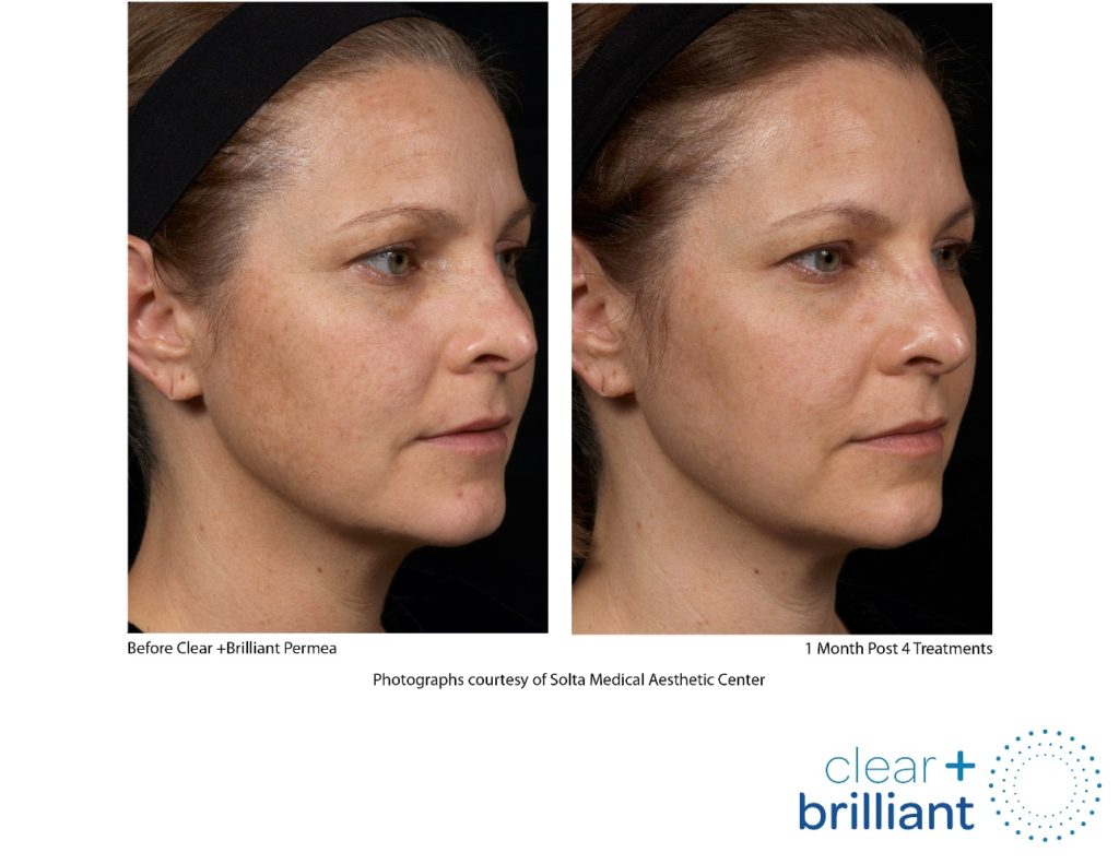 Before and after example of clear brilliant gentle laser