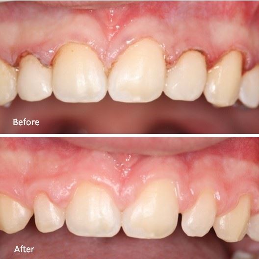 Anterior Resin Gum Recontouring Photo