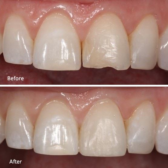 Anterior Resin of Left Front Tooth Photo