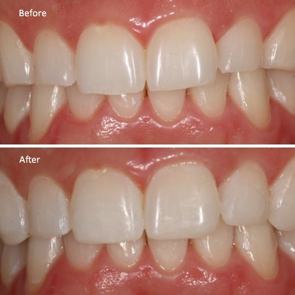 Anterior Resin of Six Front Teeth Photo