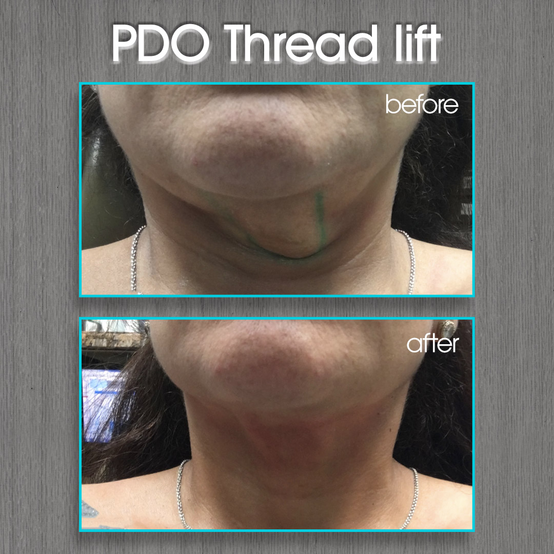 PDO Thread Lift Before and After Photo