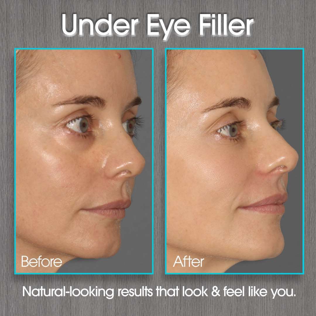 Under Eye Filler Before and After Photo