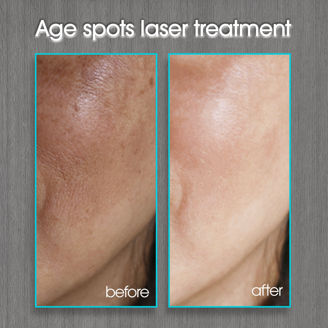Age Spots Before and After Photo