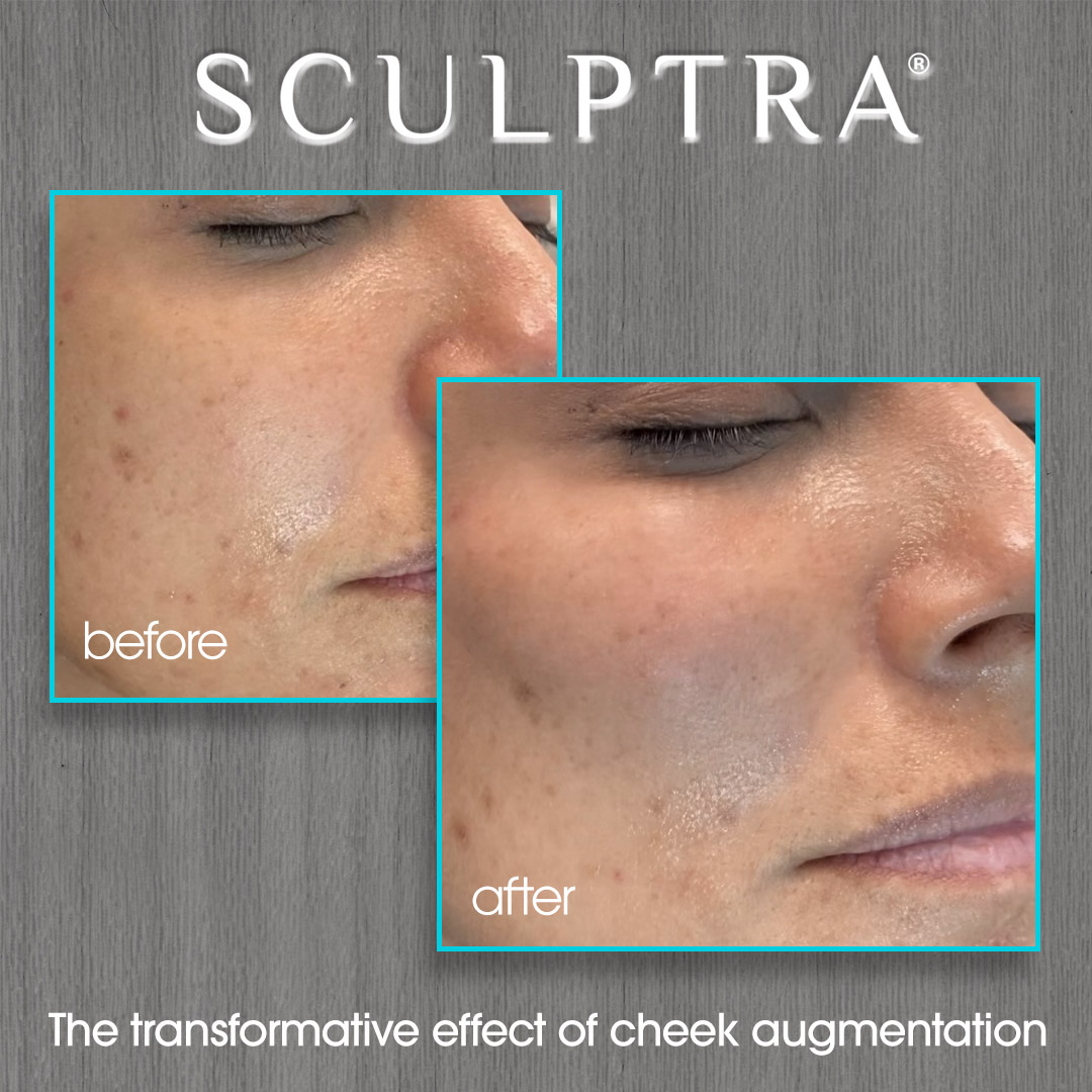 Sculptra Before and After Photo