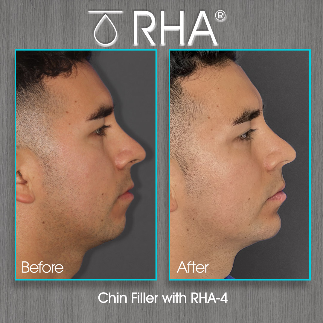 Chin Filler with RHA Before and After Photo