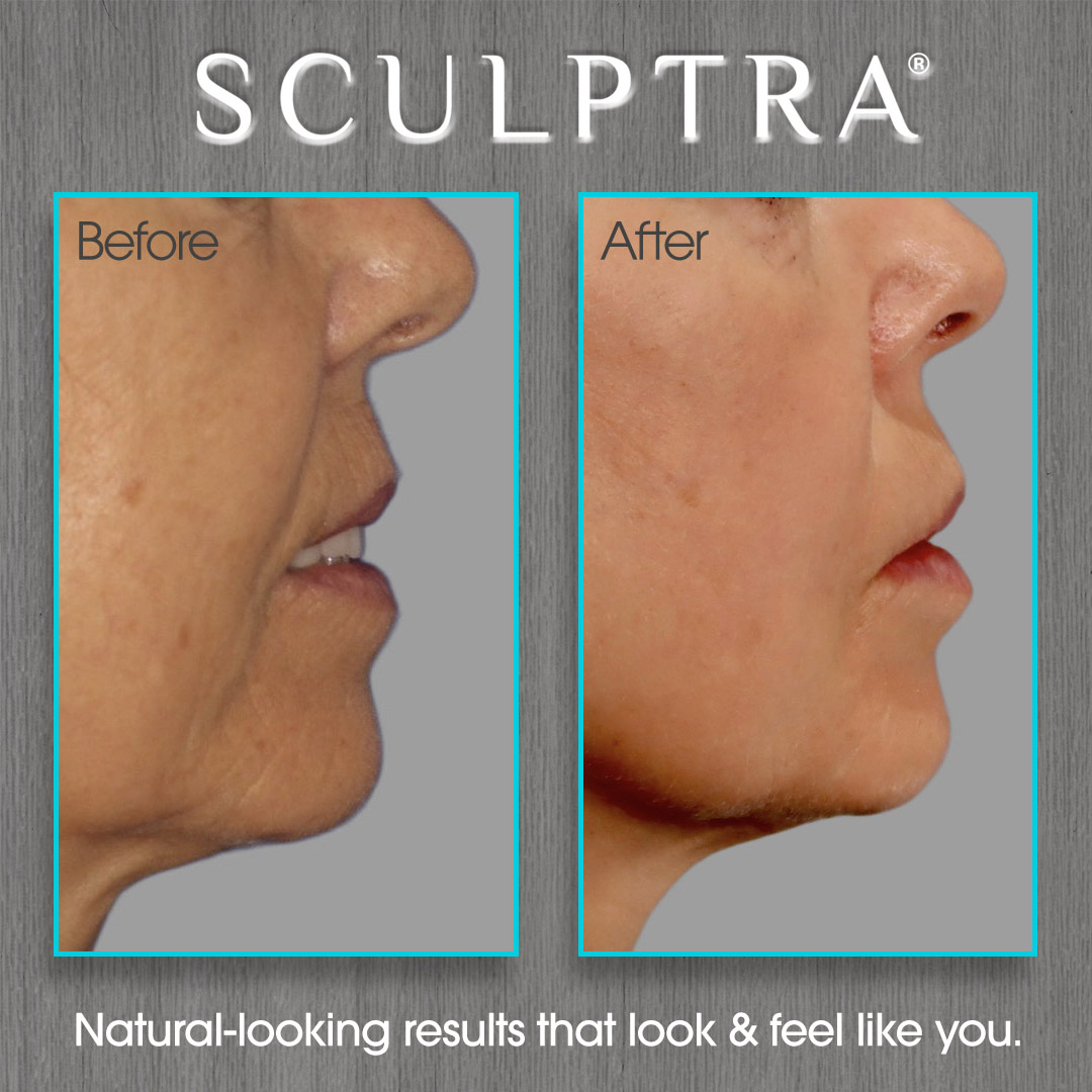 Sculptra Before and After Photo