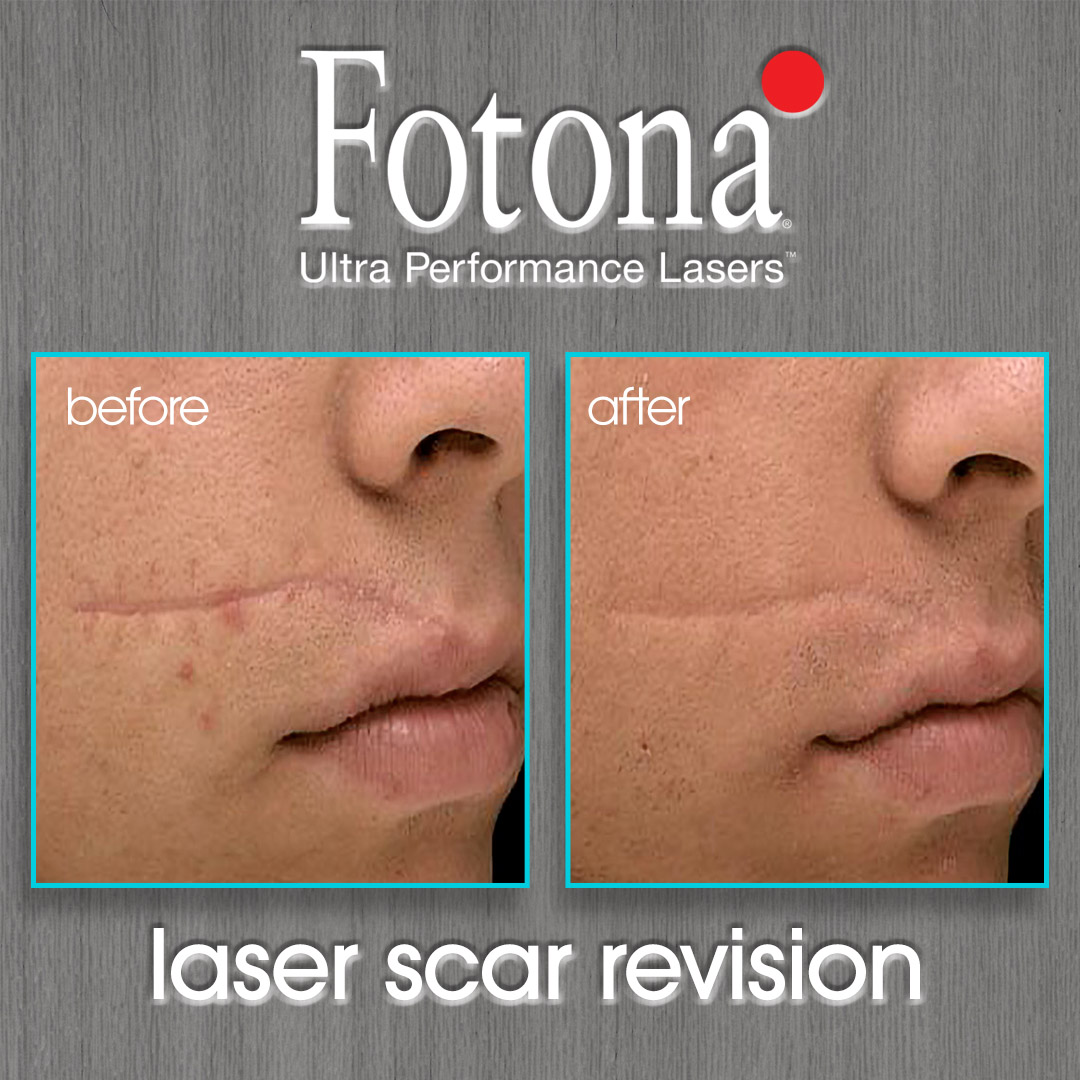 Fotona Laser Scar Revision Before and After Photo