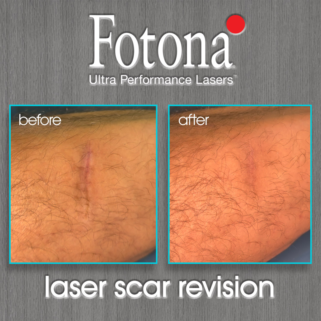 Fotona Laser Scar Revision Before and After Photo