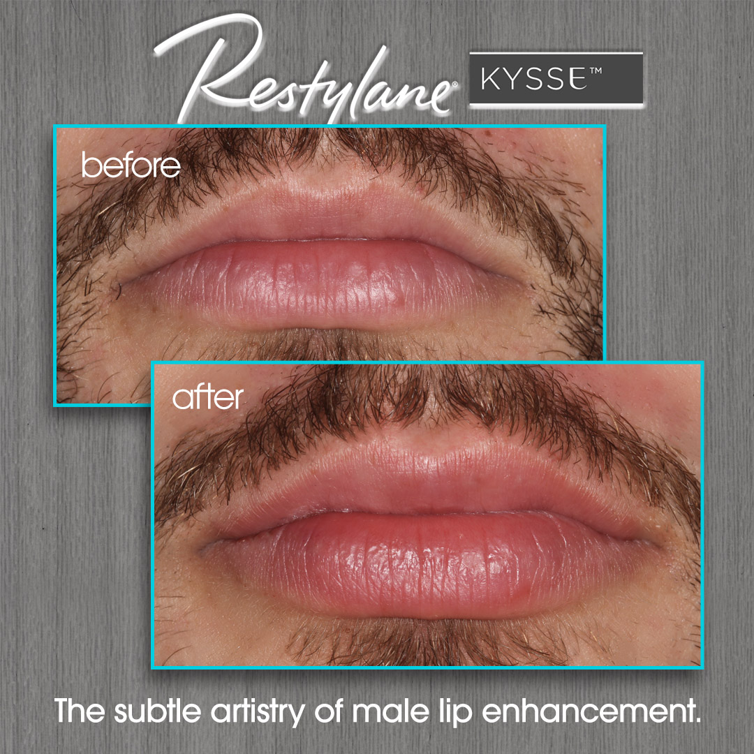 Restylane Before and After Photo