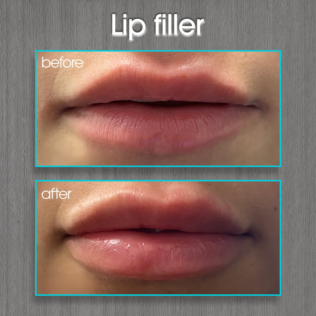 Lip Filler Before and After Photo