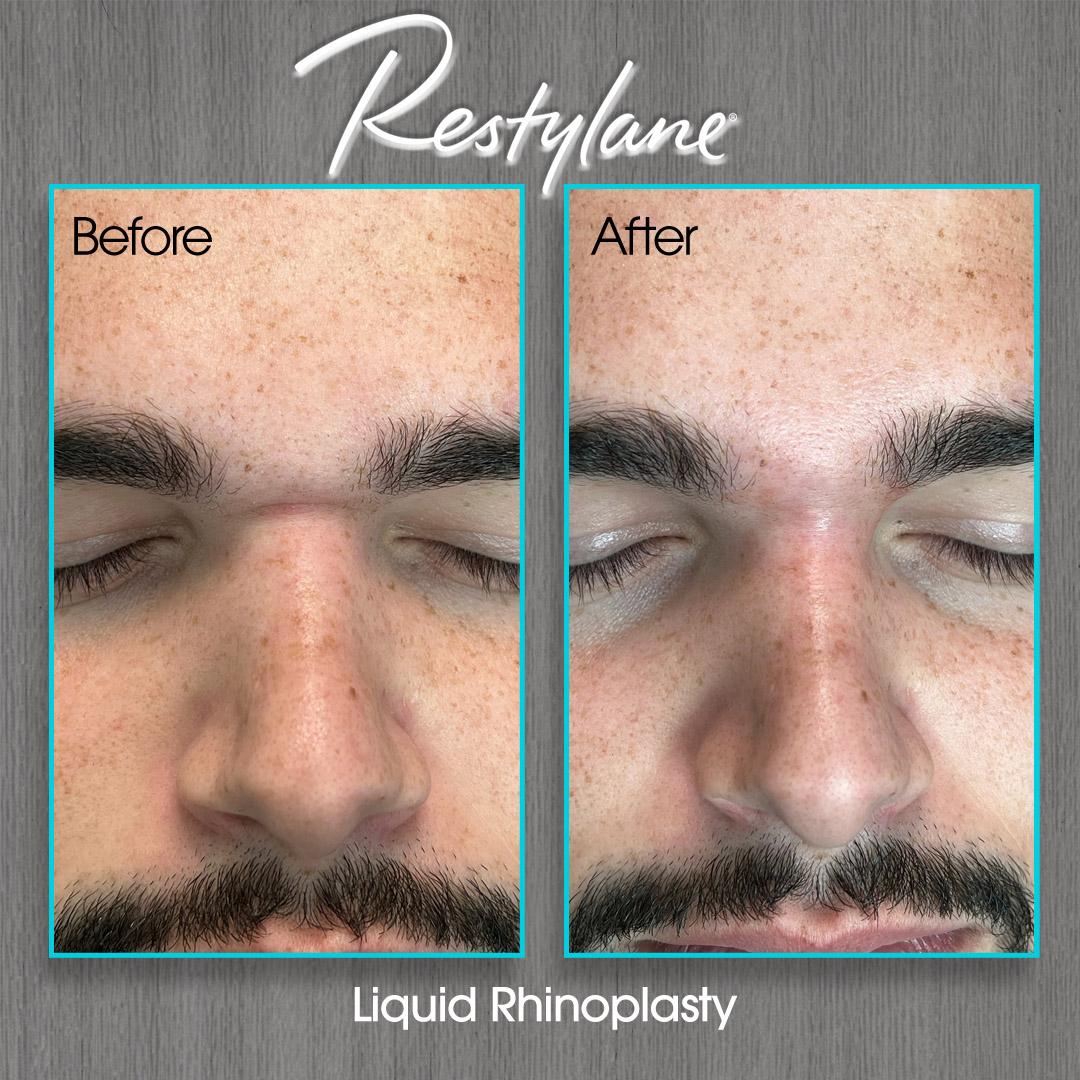 Restylane Before and After Photo