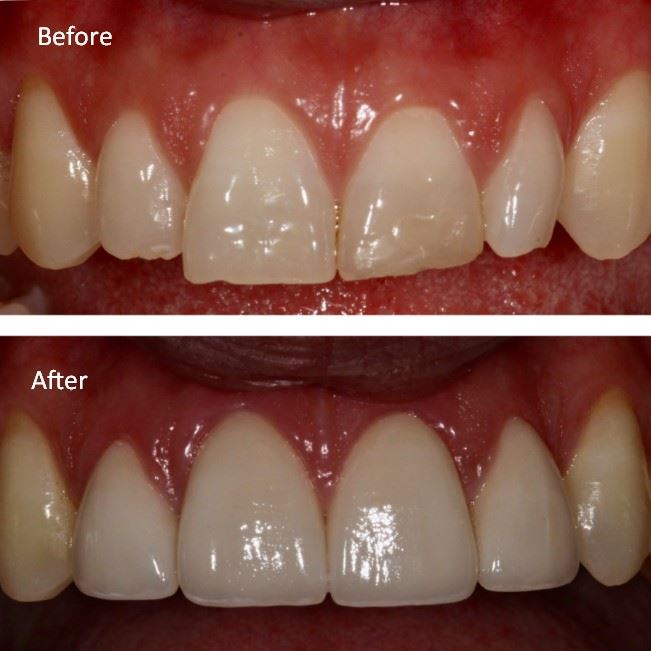 Porcelain Veneers Photo