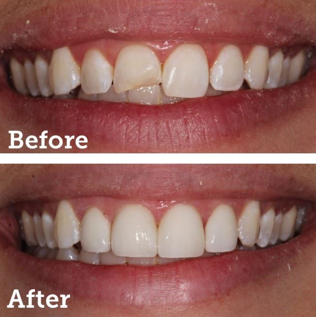 Porcelain Veneers Photo