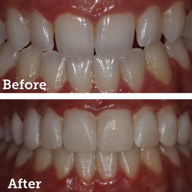 Resin Veneers Photo