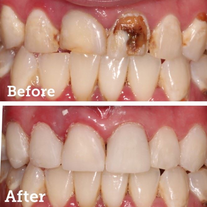 Resin Veneers Photo