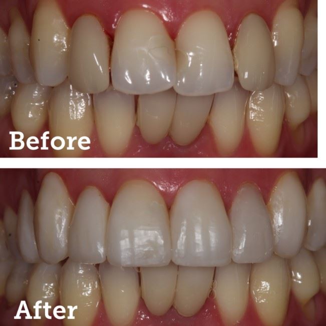 Resin Veneers Photo