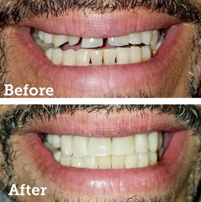 Smile Makeover- Resin Veneers Photo