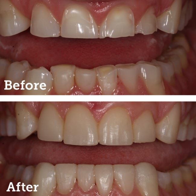 Upper & Lower Resin Veneers Photo