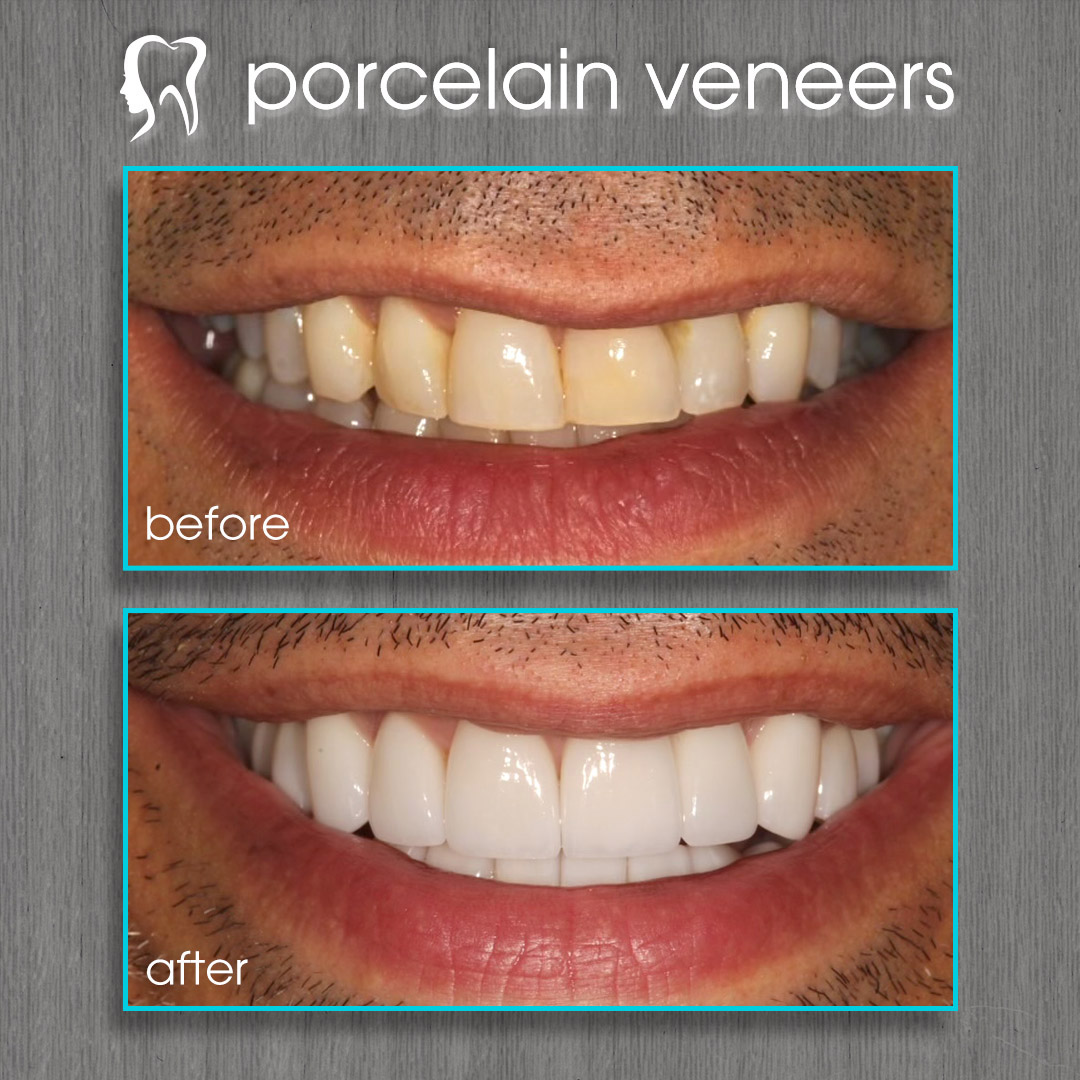 porcelain veneers
