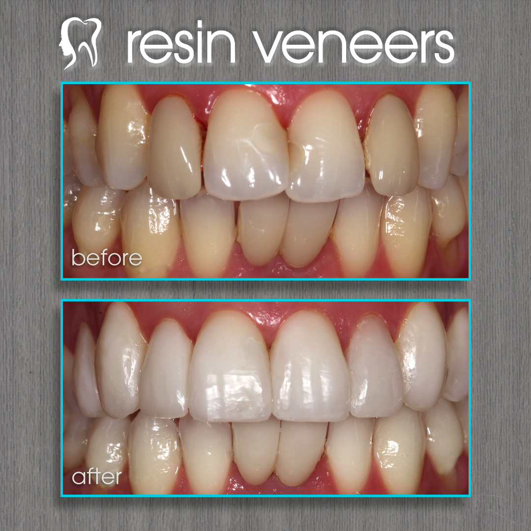 resin veneers